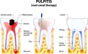 Root Canal Therapy