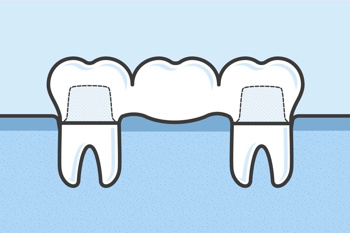 What are Dental Bridges and How Do They Work?