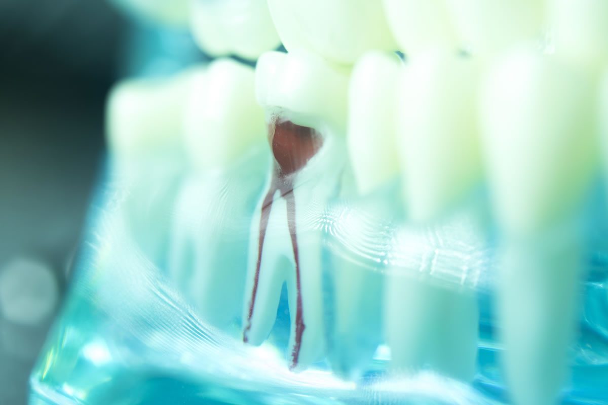 What Is Involved in Root Canal Therapy?